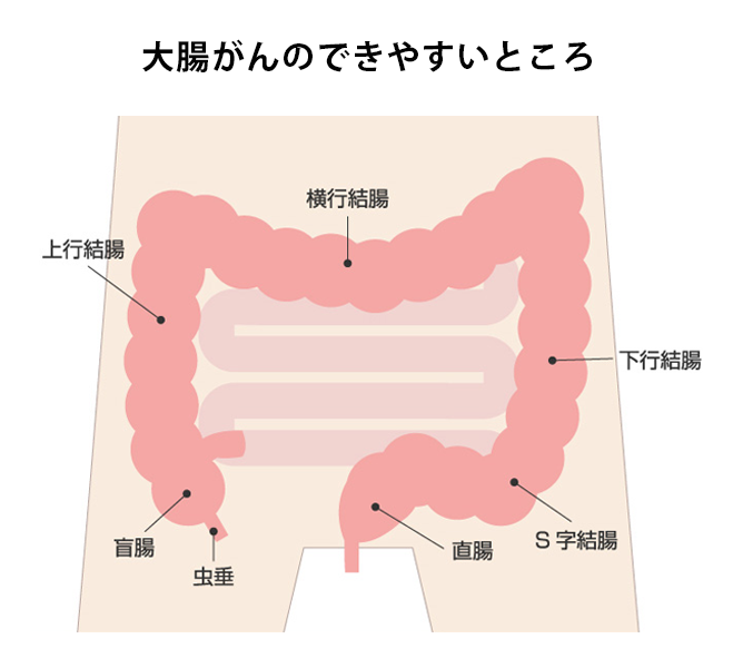 大腸がんのできやすいところ