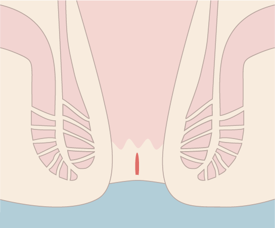 切れ痔